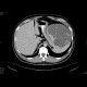 Splenic cysts, congenital, epithelial: CT - Computed tomography